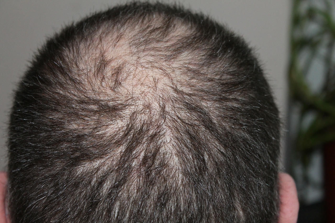 hair loss men